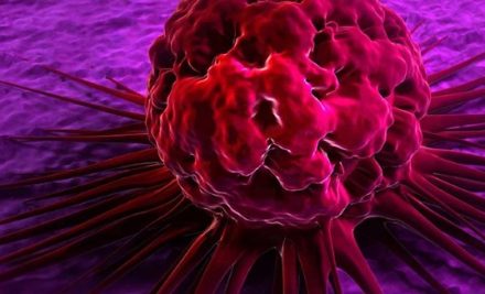 Treatment of Chronic Lymphocytic Leukemia